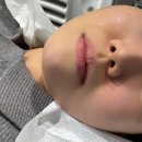 척메디칼 | 강남 온다리프팅 얼굴 축소 6만줄 후기