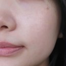 태극반점 | 흑자크림 추천 홈케어로 효과 본 훅이