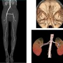 혈관 기형의 검사 - CT장비소개, 혈관조영제 및 조영검사, 조영술, MRI, MRA검사 등 소개 이미지