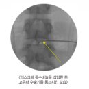 인천고주파 이미지