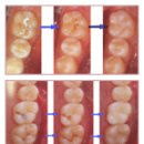 충치의 모든것 이미지