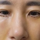 청담이지성형외과의원 | 중안면거상, 하안검 내돈내산 수술후기 [이미지 변신]