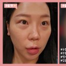 어서멍 | 30대 여자 눈밑지방재배치 한 달 후기, 무드온 눈밑지 브이로그📺