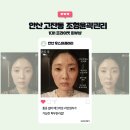 후스파 갤러리 | [경기/안산] 후스파갤러리 얼굴축소와 이중턱리프팅, 통증 없이 브이라인 만든 솔직 후기!