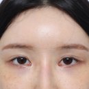 다비다성형외과의원 | 다비다성형외과에서 눈재수술하고 회복 중!