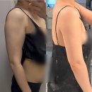 (주)가치같이 | [결혼 준비] 일산 365 팔뚝 무한람스 시술 2-3주차 후기 (후관리 리포덤 중저주파 레이저)