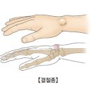 결절종(Ganglion) 이미지