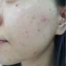 아크네마인드의원 | 압구정 여드름 전문 의원 아크네마인드에서 여드름, 모낭염, 흉터 치료 내돈내산 솔직 후기-1