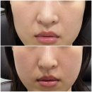 필업(느낌이좋은) | 땅콩형 얼굴 볼꺼짐 필업콜라겐 으로 채운 후기