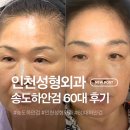 연세대학교내 및 입구 | 송도 하안검 잘하는 인천성형외과 60대 엄마 시술 후기(전후 비교, 회복 기간 등)