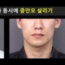 양악수술[double jaw surgery] 이미지