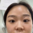 김지현피부과 | [연수김지현피부과/내돈내산]점 뺀후기