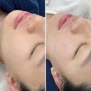 시엘 메디칼 | 대전 유성 피부관리 : 대전피부관리 유성 프리시엘 스킨 여드름흉터 슈퍼젝션으로 극복 후기 ♥