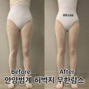 안양범계 허벅지 지방흡입 무한람스 두달차 효과 및 바이오본드와 흉터에 대한 솔직후기