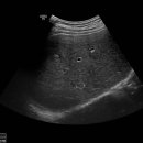 hemangioma 이미지