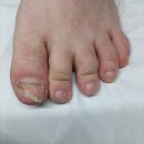 [구로 내성발톱병원] 서울늘봄메디칼의원에서 발가락 통증 탈출 성공! 🦶✨