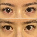 아이써마지 FLX + 아이리쥬란 효과 후기 (아이리쥬란 캐뉼라)