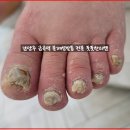 금곡약국 | 남양주 금곡역 문제성발톱 전문샵 풋풋한리쌤