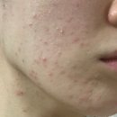 이현주한의원 | 부평피부관리 내돈내산 브이메디스파 여드름 홈케어 제품 추천