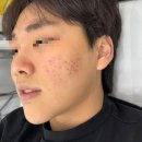 다모아프라자 | 수원 영통 여드름 전문 관리 resolu 후기
