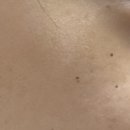 엄피부과의원 | [창원 피부과] 창원 댄의원 잡티제거 레이저 솔직 후기