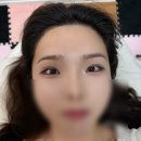 라인헤어 - 김천시 | 수원 인계동 가루헤어라인 솔직후기(티 안 나게 예뻐지는 시술)