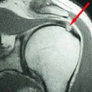 충돌 증후군(impingement syndrome) 이미지