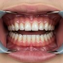 다니치과의원 | 투명교정기 가격, 투명교정 직접 착용 후기