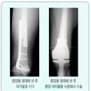 골육종(Osteosarcoma) 이미지