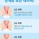 항문이 아파요 항문 통증 원인 및 예방 이미지