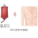 백혈병은 무엇인가? 백혈병에 대해 알아보자!
