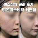트로이샵 | 분당서현역 피부관리샵 추천 휘온에스테틱 여드름 색소침착 모공관리 트로이필 찐변화 후기