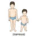 연골무형성증 (Achondroplasia) 이미지