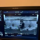 아산유외과의원 | [갑상선암 투병일기 1] 건강검진 및 아산유외과 세침검사 후기