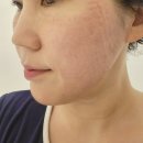 샤이닝 | 스킨부스터 리비힐 샤이닝 시술 후기 (내돈내산)