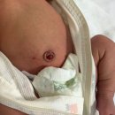 배꼽 - 유성구 | 신생아 배꼽 육아종 후기｜배꼽 탈락 후 빨간 물집? 질산은 소작술 치료까지