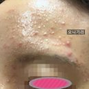 코끼리한의원 | [피부] 한의원에서 스테로이드 부작용 치료 중 여드름 박사 된 후기