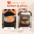 멍클린 | 하남 복부 지방흡입주사 1주일차 후기 멍, 부종 빨리 빼는법 (식단,운동)