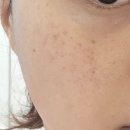 메이퓨어의원 하남점 | [23] 메이퓨어의원 피코토닝 비추 후기