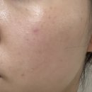 메디큐브의원 | [서현] 메디큐브의원 분당서현점 잡티제거 내돈내산 후기 | 아꼴레이드 + 피코토닝 | 레이저 후 관리 법