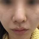 멍무드 | 얼굴 팔자주름시술 전후 쥬베룩 손주사 멍 엠보 강남피부과전문의 후기