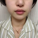 바른윤곽치과병원 | 구월동 피부과에서 인모드&amp;윤곽주사맞고 3주차 솔직 후기!(병원정보, 가격공유)