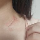 선암약국 | 갑상선암 수술 후 흉터관리 잘못하면 이렇게 됨 (갑상선 흉터 변화 과정 공개, 메피폼 사용법)