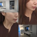 신사동-1 | 신사동피부과 티타늄리프팅 1주 후 느낌 내돈내산 솔직후기