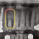 보정역 | 보정역치과 추천? 과잉진료 걱정되는 분만 보세요