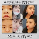 강남대로4-7 | 강남 자가늑 코수술 성형외과 내돈내산 찐후기 2주차 붓기 후기 정리 4탄 콧볼축소 실밥 제거까지