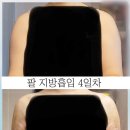 부산 서면 모델라인 ★팔 지방흡입 회복 리얼 후기