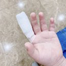 광개토병원 | 어린이 손가락 화상 : 대구<광개토병원> 치료후기 /feat.그놈의달고나