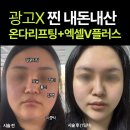 라인플러스호텔 | 내돈내산 온다리프팅 엑셀V플러스 후기 (ㄹㅇ대박임) 당일~1일차 전후비교