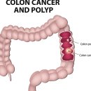 &#34;대장암, 발생 부위 따라 생존율 차이&#34; - 혈관 조영술, 암 수술... 의학 이라는 괴물, 인간이라는 기물/ 사탄, 악마, 독사의 자식들... 이미지